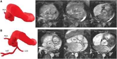 Addition of gadolinium contrast to three-dimensional SSFP MR sequences improves the visibility of coronary artery anatomy in young children